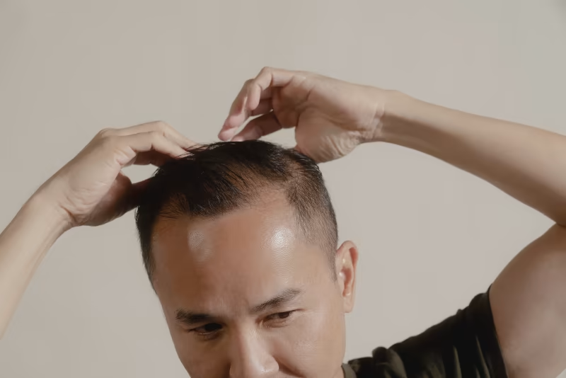 Top Hair Loss Medicines for Men: Options, Effectiveness & Safety